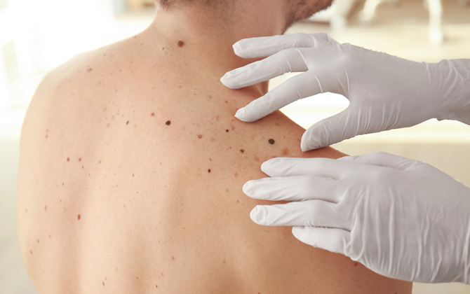 Рак кожи: дерматолог назвал участок тела, которому стоит уделять особое внимание